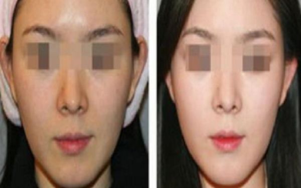 假體隆鼻價(jià)格、效果及相關(guān)信息