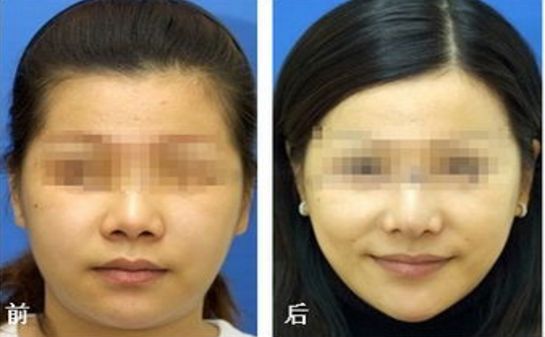 透明質(zhì)酸隆鼻價(jià)格多少？價(jià)位調(diào)查報(bào)告來襲！
