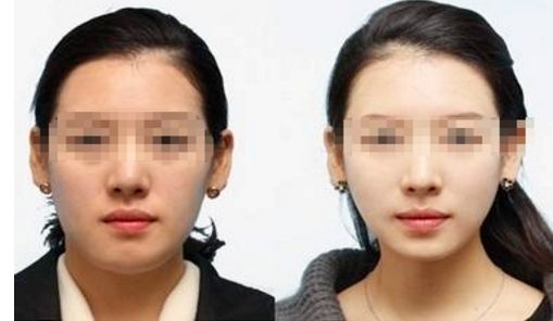 彩光嫩膚：一個(gè)療程要多少次才有效？
