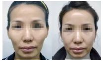 SMAS除皺是安全高效的解決皺紋問(wèn)題的神奇術(shù)