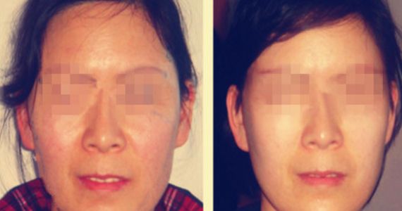 opt光子嫩膚費用及價格查詢詳解，了解opt光子嫩膚真實價格與口碑評價