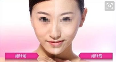 耳朵重塑技術(shù)是否優(yōu)質(zhì)？整形手術(shù)費(fèi)用如何評(píng)估？