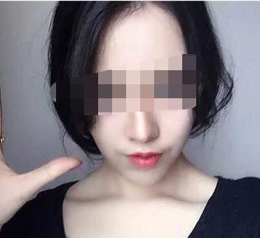 穆雄錚顴骨整形手術解析，修復顴弓美麗重生！顴骨整形術后恢復時間淺析