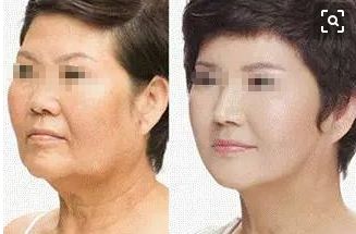 15歲女孩整容成果驚人！爸媽都認不出來了