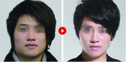 隆鼻修復，如何科學達到理想效果？