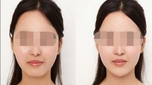 雙眼皮修復(fù)的方法有哪些？解析雙眼皮修復(fù)技術(shù)簡介