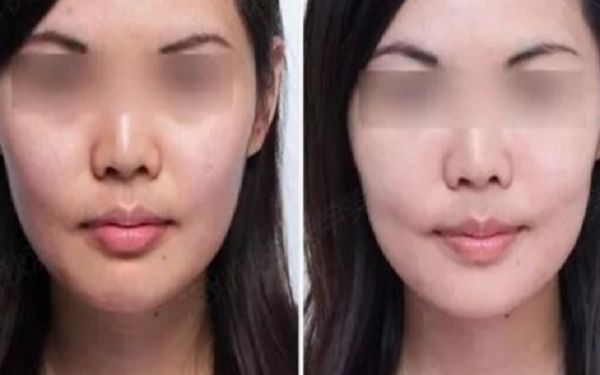 35歲采用超聲療程好還是熱瑪吉更好？匿名評測揭秘！