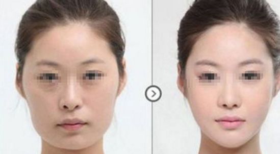 皮膚松弛，如何選擇適合的醫(yī)美項目？熱門方式如熱瑪吉、拉皮等對比解析！