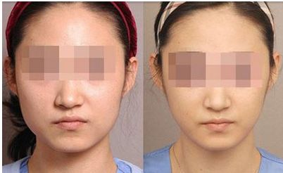 有效去眼袋方法分享：激光手術(shù)后的正確護理