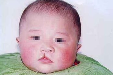處女膜修復(fù)術(shù)后多久能恢復(fù)正常？