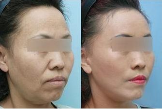 施爾美腹部抽脂：手術(shù)后保持效果長久嗎？