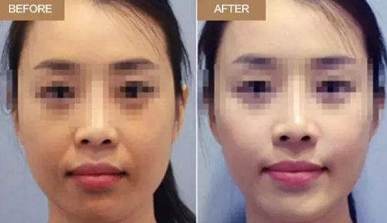 武漢注射法隆鼻價(jià)格、適宜人群都想知道