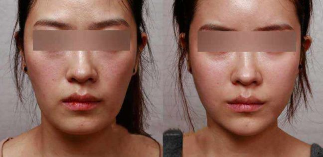 眼袋手術(shù)后效果持續(xù)多久？解析專家分享