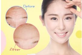 開內眼角手術的疼痛程度如何？解析內眼角手術的全貌