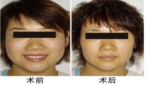 咬肌切除手術(shù)后對(duì)面部功能是否會(huì)受影響？