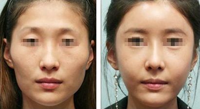 雙眼皮修復的關(guān)鍵時期，如何有效解決手術(shù)失敗問題？