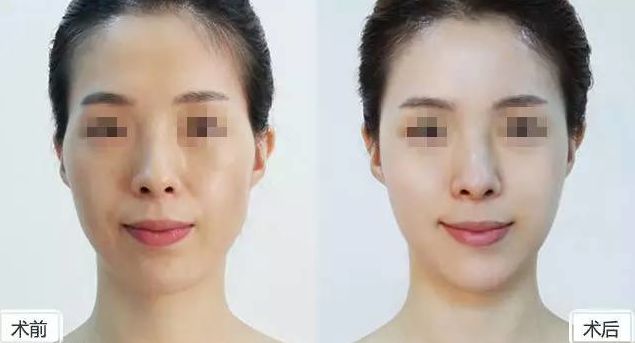假體隆胸保持持久效果有多久？假體隆胸2個月后是否固定？