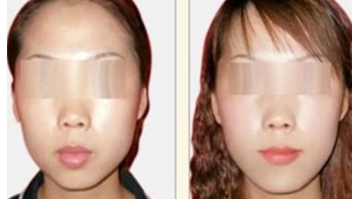 打造明亮迷人雙眼，領(lǐng)略三點雙眼皮手術(shù)的魅力
