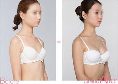 成都耳軟骨復(fù)合隆鼻手術(shù)：專家解析耳軟骨隆鼻效果及價(jià)格、術(shù)后護(hù)理
