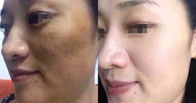 淚溝填充：熊貓針VS膠原蛋白，手術(shù)過程與注意事項(xiàng)解析