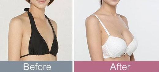 腹腔抽脂對(duì)生育有影響嗎？