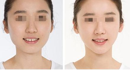鼻整形手術價格分析：效果原理講解，術后注意事項，不良反應剖析