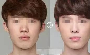 透明質酸隆鼻：為你打造完美鼻形的幾大優(yōu)勢