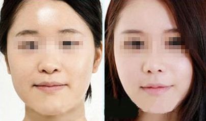 激光祛胡脂肪堆積有安全風(fēng)險(xiǎn)？您了解情況嗎？