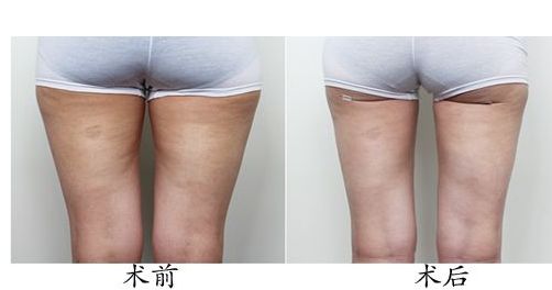 體驗光子嫩膚，解密北京光子嫩膚價格