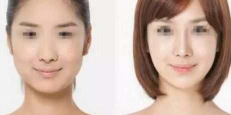 雙眼皮修復(fù)術(shù)最佳時機是什么時候？