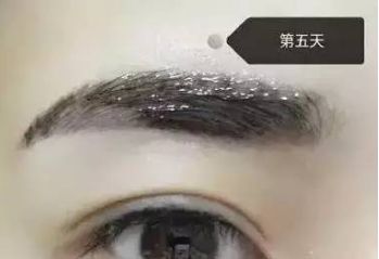 南昌美伊爾劉立軍醫(yī)生膨體隆鼻整形費(fèi)用？手術(shù)效果如何？帶您看醫(yī)生案例