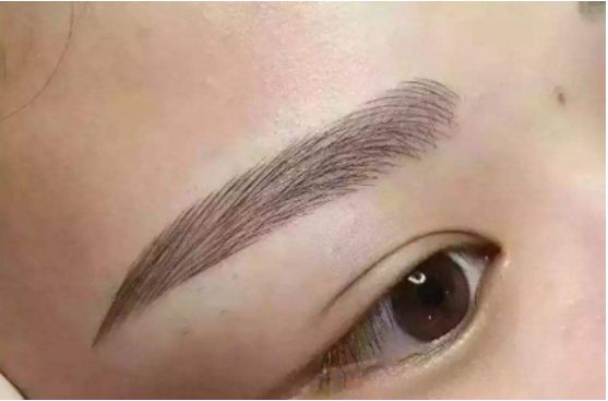 武漢葉子榮做拉皮的療效如何？專家醫(yī)生分享經(jīng)典案例