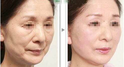 上海哪家磨骨醫(yī)院靠譜？華美、美聯(lián)臣、薇琳資歷雄厚值得信賴