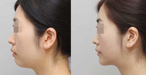 長春哪家醫(yī)院治療肋骨鼻效果好，推薦這些知名醫(yī)院