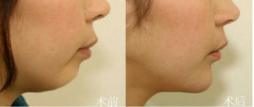 泉州最佳醫(yī)院推薦！一流技術(shù)與超高性價比，助您邁向完美美容整形！