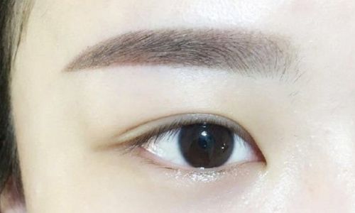 北京郭建玲雙眼皮手術(shù)費用是否昂貴？醫(yī)生案例分享全面解析