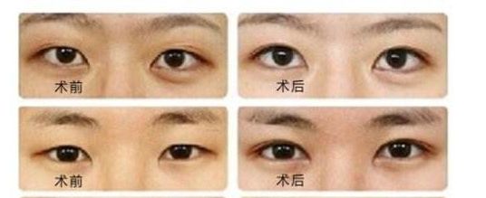 菲塑美減肥針：效果評(píng)估、價(jià)格和潛在風(fēng)險(xiǎn)全解析