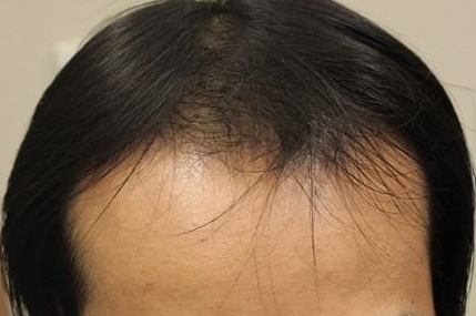 安慶整形美容醫(yī)院都有哪些？哪家公立整形科口碑比較好？價(jià)格一覽_附專家解讀