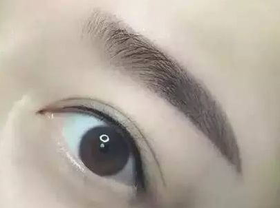 蘇州圣愛醫(yī)院整形科：90天變化揭示，雙眼皮驚喜盡顯！