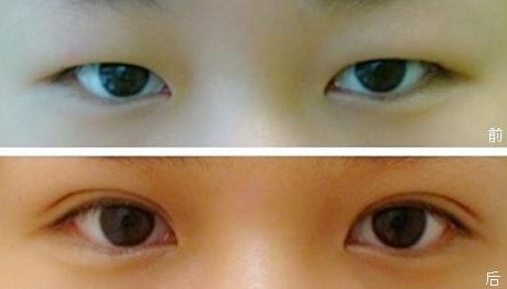 上海九院雙眼皮手術(shù)效果怎么樣？錢(qián)云良醫(yī)師的全新案例分享