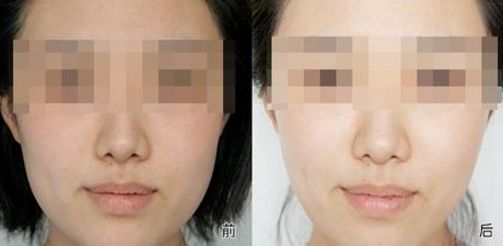 【揭秘】成都雙眼皮醫(yī)院最佳選擇，眼部微創(chuàng)手術秘訣大公開！