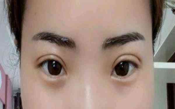 丁硯江填充脂肪的效果如何？為什么該方法備受推崇？