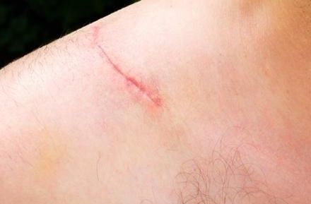 八大處張超面部吸脂效果解析：醫(yī)生技術(shù)實(shí)力、案例與價(jià)格