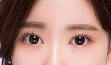 鄭州葛艷娜雙眼皮整形技術(shù)及真實案例分享 鄭州葛艷娜雙眼皮整形技術(shù)及真實案例分享