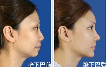 上海九院鼻部整形手術(shù)專家李圣利，專業(yè)水準(zhǔn)如何？