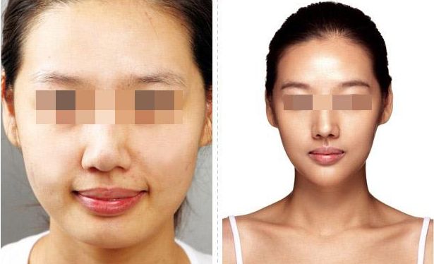 武漢恩娜整形中心：解讀雙眼皮手術(shù)全攻略，案例展示讓你真實(shí)了解效果！