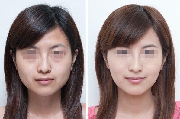 鄭州假體隆胸：哪家醫(yī)院在同類(lèi)榜單有亮眼表現(xiàn)？