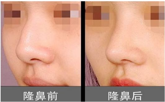 上海柴云醫(yī)生雙眼整形效果完美！手術(shù)前后真實照片呈現(xiàn)出專業(yè)水平
