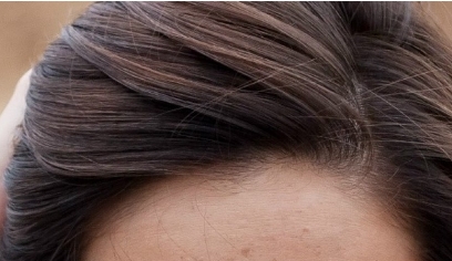 南昌二附院整形科眼袋抽脂效果好嗎？值得醫(yī)生推薦嗎？