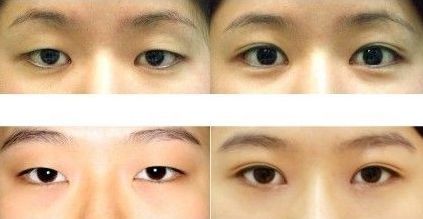 北京首家細(xì)致公正：觸手可及的雙眼皮整形醫(yī)生排名初現(xiàn)時！